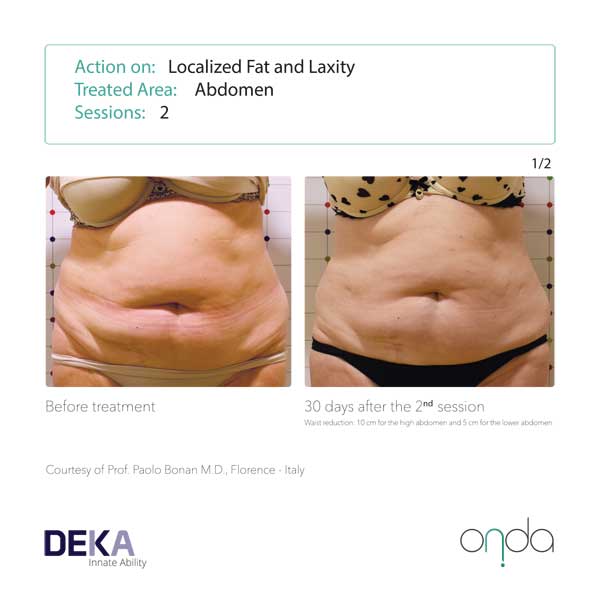 ONDA BODY SCULPTING – ACLC